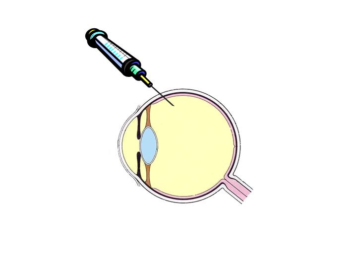 intra vitreous injection