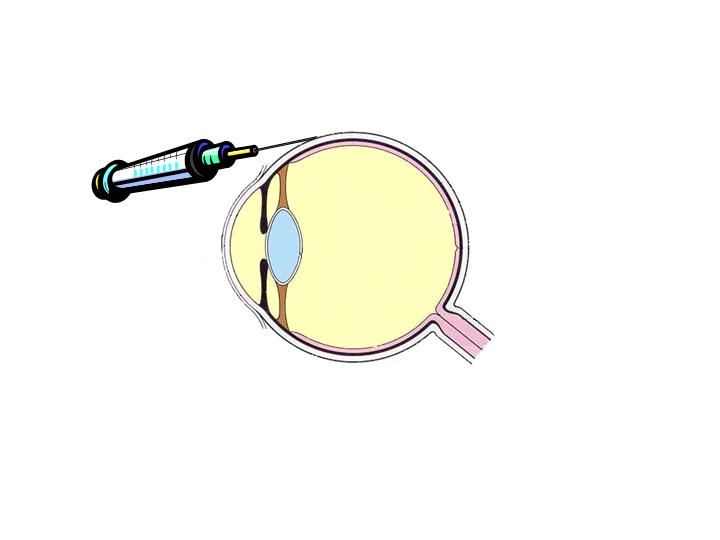 sub-conjonctival injection