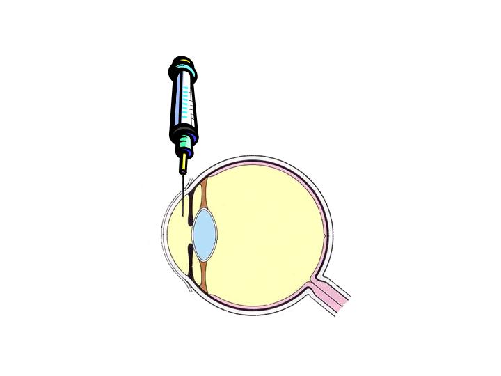 Anterior chamber injection