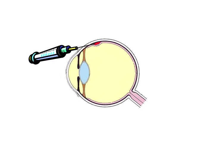 sub-retinal injection